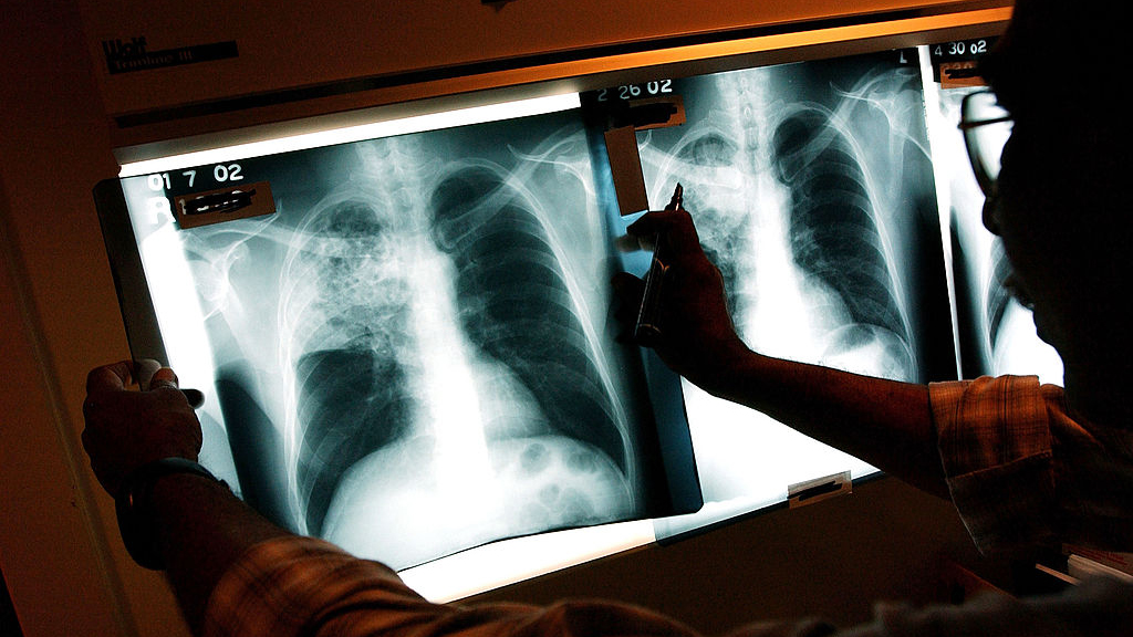 2 active tuberculosis cases traced to San Francisco strip club — KTVU FOX 2 Bay Area, Danville Health news